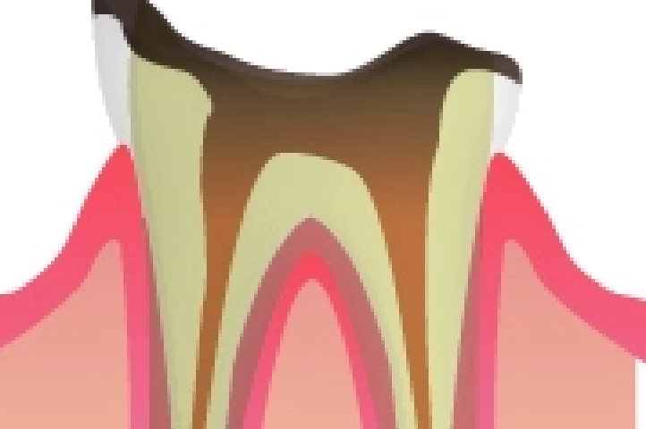 むし歯治療
